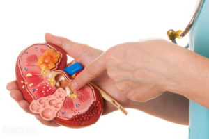 мочекаменная болезнь