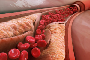 атеросклероз сонных артерий