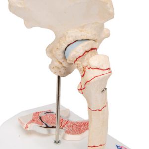 Диагностика перелома бедренной кости