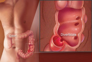 Диагностика дивертикулеза кишечника в Запорожье