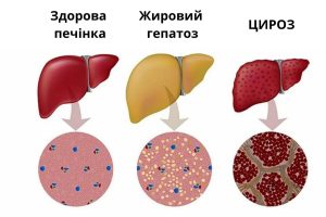 Жировой гепатоз печени: диагностика и лечение