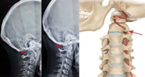 Аномалия Кимерли на КТ